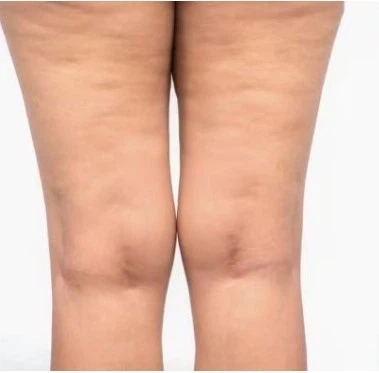 cellulite removal cellulite removal
